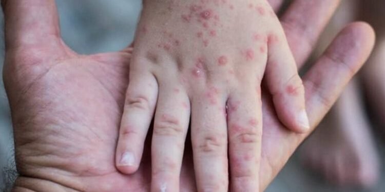 Dinas Kesehatan DKI Jakarta Intensifkan Promosi Kesehatan Terkait Kasus Mpox