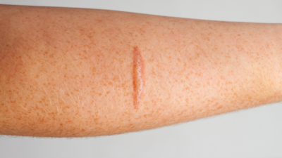 penyembuhan luka