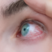 retinopati diabetik